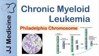 Chronic Myeloid Leukemia (CML) | Pathogenesis, Symptoms and Treatment