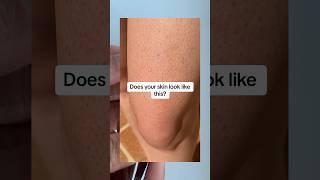 Do you have Keratosis Pilaris?