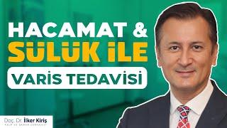 Sülük ve Hacamat ile Varis Tedavi Edilir mi?  | Doç. Dr. İlker Kiriş