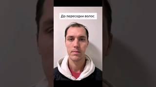 Пересадка волос | Пересадка волос в Турции #пересадкаволос #пересадкаволосвтурции