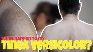 Tinea Versicolor Update | Ap-ap | itsme_Rocky