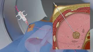 Lung Tumor Biopsy