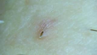 Gross! Removing an ingrown pubic hair!!!!