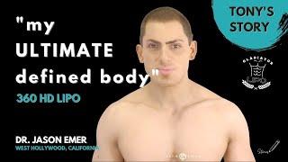 Male “Gladiator” 360 HD Lipo: Before & After Tony’s Journey to His “Ultimate Defined Body” -Dr. Emer