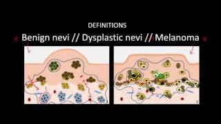 Introduction to Skin Cancer #3: Overview of Nevi and Melanoma