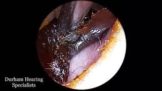 Peeling black earwax and dead skin off the ear canal