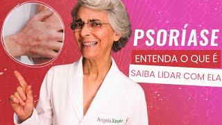 Psoríase: entenda o que é e saiba lidar com ela