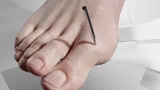 Minimally Invasive Hallux Valgus Bunion Surgery