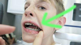 GETTING RUBBER BANDS WITH BRACES