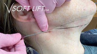 Neck Lift Using PDO Lifting Threads