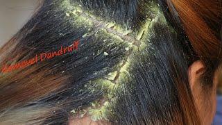 Removal Dandruff Flakes With Lice Comb  Psoriasis Flakes Scalp # 1550