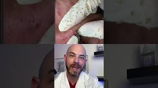 Derm reacts to pus-filled pimple pop! #dermreacts #doctorreacts #pimplepop