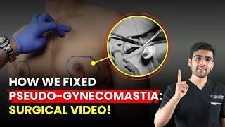 Gynecomastia Vs Pseudo Gynecomastia: Causes, Diagnosis, and Treatment! | Chest Fat Reduction | Dr DC