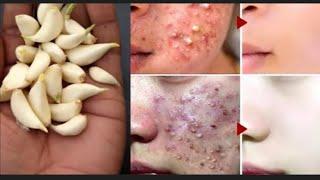 Pimples removal on face pimples removal home remedy|Acne new 2025|acne treatment at home