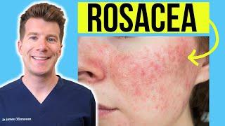 Doctor explains ROSACEA | Skin Condition - Causes, Treatment and more!