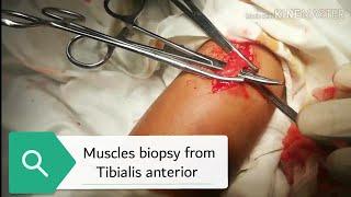 Muscle biopsy | muscle biopsy from tibialis anterior| surgery | medico mnemonico