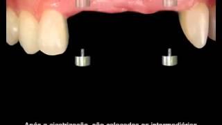 Dentista - Protese Fixa Sobre Implante Dentário