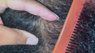 Satisfying Ingrown|Compound Hair Removal