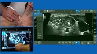 Interscalene Brachial Plexus Block