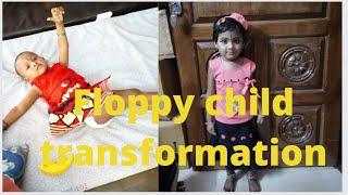 FLOPPY CHILD One year transformation.cp child success story