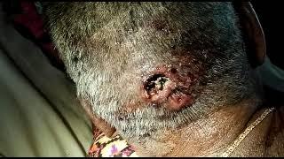 Maggots in a scalp wound | Worms in the head