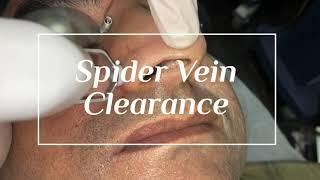 Spider Vein Clearance