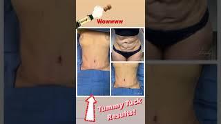 Amazing Tummy tuck Results !!! | Dr Jeneby Before and After Pictures