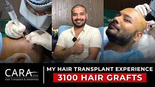 My Sapphire FUE Hair Transplant Experience.