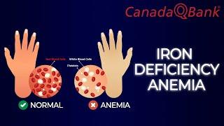 Iron Deficiency Anemia