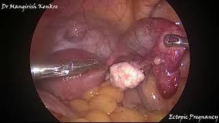 Patient Info- Ectopic Pregnancy