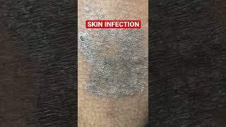 #skininfection #khujli #eczema