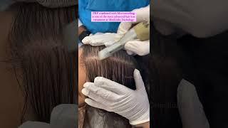 PRP ( Platelet-Rich Plasma ) Best Hair Treatment | #shortsfeed #shorts