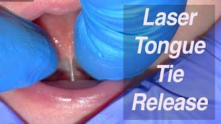 Laser Tongue Tie Release