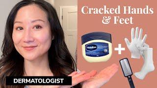 Heal Dry & Cracked Hands & Feet with This Quick Dermatologist Tip
