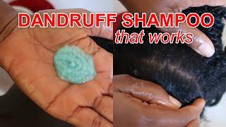 Best SHAMPOO for Dandruff | How to use Nizoral Anti-Dandruff Shampoo | Discoveringnatural