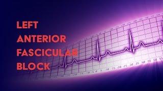 Left Anterior Fascicular Block - How to Read an Electrocardiogram (EKG) - MEDZCOOL