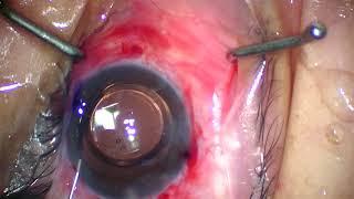 Cataract surgery by Dr. Jeffrey Huang vlog 4