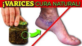 GET RID of VARICOSE VEINS in the LEGS QUICKLY! | POOR CIRCULATION NATURAL TREATMENT