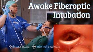 Awake Fiberoptic Intubation