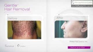 Gentle Hair Removal - GentleMax Pro Laser - Treatment