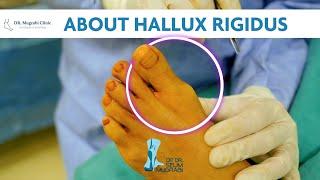 What’s our difference? / Hallux Rigidus - Op. Dr. Selim Muğrabi