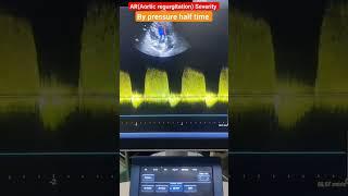 Aortic pressure half time measurement by echo l PHT lAR #shorts