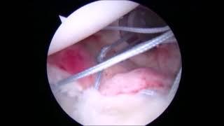 Arthroscopic Techniques to Stabilize Glenoid Bony Bankart Fragments