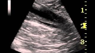 ultrasonographic video clip of ectopic ureter in a dog