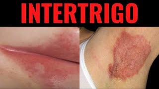 What is intertrigo?  Intertrigo definition, Causes, Symptoms, Treatment, Risk Factors, USMLE