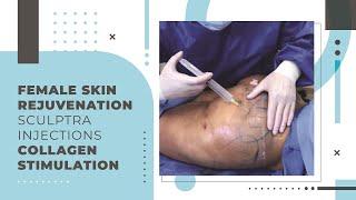 Female Skin Rejuvenation | Sculptra Injections | Collagen Stimulation