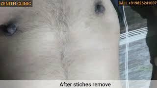 Best results keyhole female to male top surgery | FTM Top Surgery Result After 1 Month