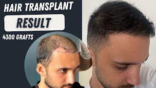 Hair Transplant Result 4300 grafts l Before and After 10 months l Hair Transplant in Turkey