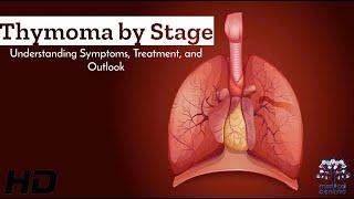 Decoding Thymoma: A Stage-by-Stage Guide to Symptoms & Treatment