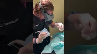 Cyst Excision on the Sternum at Las Vegas Dermatology